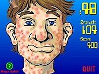 Acne Be Gone